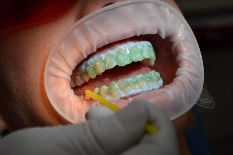 Карыес пераможаны: навукоўцы стварылі гель для аднаўлення зубной эмалі